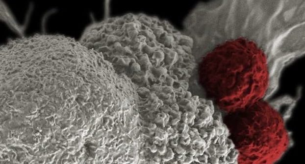 Λεμφοκυτταρική Λευχαιμία