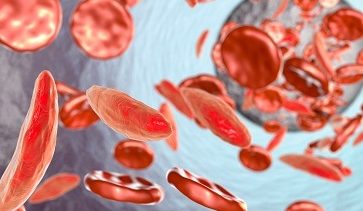 δρεπανοκυτταρική αναιμία