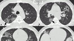 ΘΡΟΜΒΩΣΗ ΑΝΤΙΠΗΚΤΙΚΗ ΚΟΡΩΝΑΪΌΣ