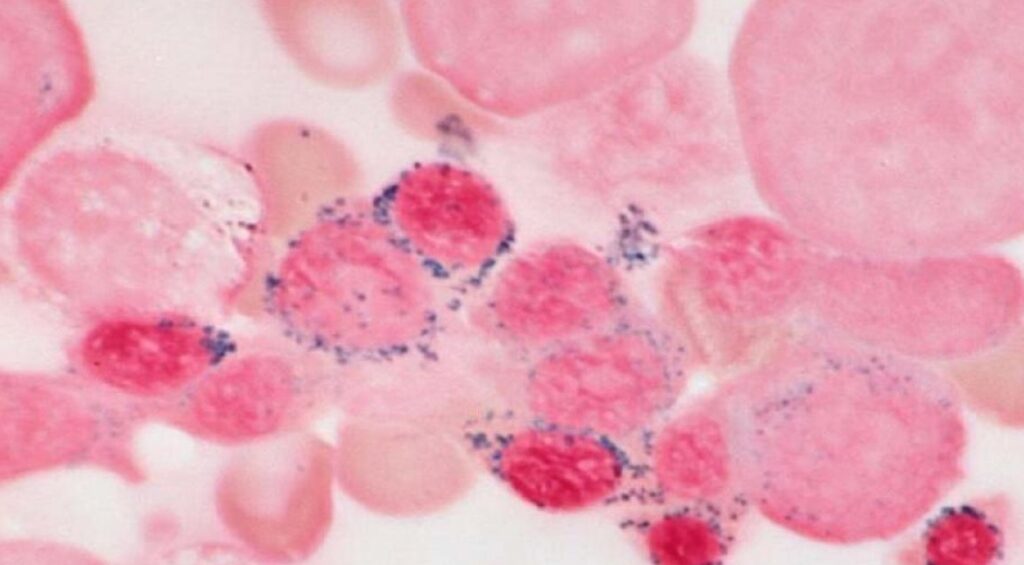 Μυελοδυσπλαστικά Αναιμία ερυθροβλάστες