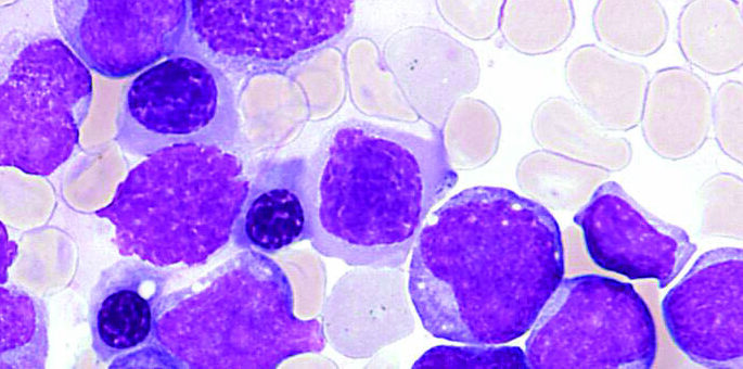 λευχαιμία θεραπεία καρκίνος