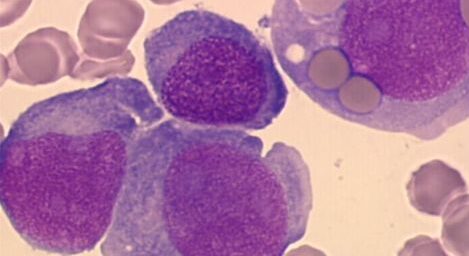 οξεία μυελογενής λευχαιμία