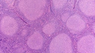 λέμφωμα οζώδες πρόγνωση